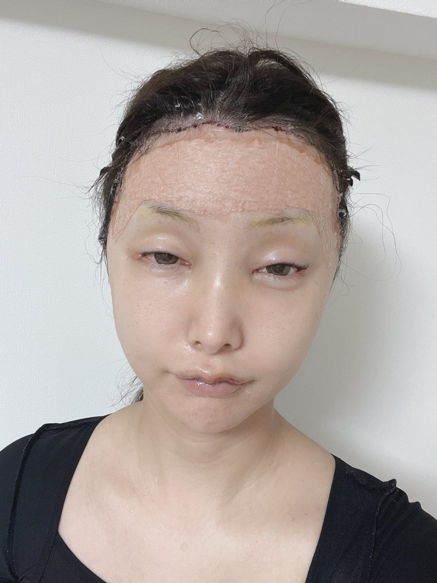 yoshikawachie's tweet photo. 成長因子入りのPRPは
絶対に入れないで下さい…。
私は過去に額に注入したのですが、
数年経つ事膨れ上がりました。
こんな額になりたいですか？？
そして、成長因子入りのPRP除去手術で
額の傷がこんなに残りました…
除去手術する金額も高く、
精神的にもかなり辛いです。
私みたいになりたくない人は絶対入れないで！！
※注意喚起としてRT拡散よろしくお願いいたします🙏
