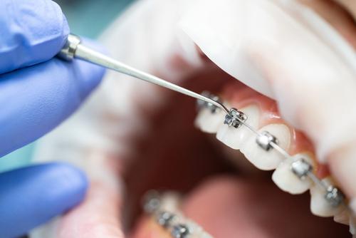 RiiliStudio's tweet photo. L’ortodonzia è la disciplina specialistica che si occupa della diagnosi e della correzione delle posizioni anomale dei denti rispetto alle arcate, ovvero delle malocclusioni.
#Ortodonzia #Malocclusioni #Denti
#StudioDentisticoRiili
#StudioDentistico
#Siracusa 
#ANDI https://t.co/pUvc3cBrPy