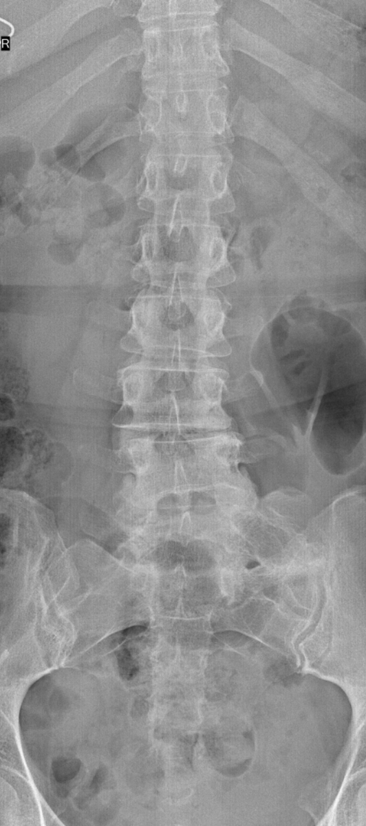 Lumbosacral transitional vertebra #foamed #foamrad #elearnrad #drbabu #rad #radres #kuwait #medtwitter #radiograph #xray #msk #ortho #mskrad