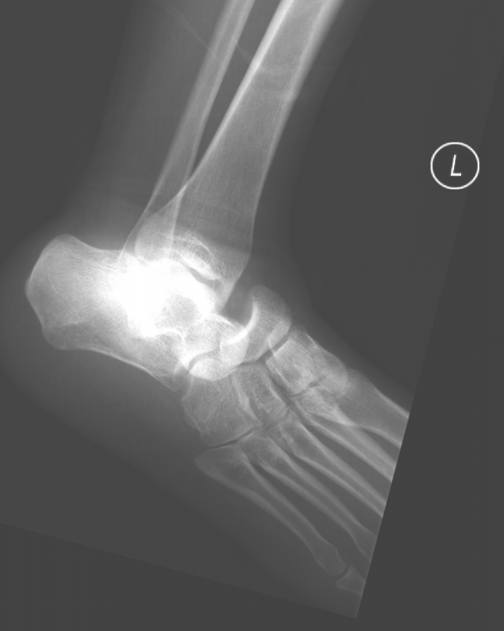 Subtalar dislocation Talocalcaneal and talonavicular joints #foamed #foamrad #elearnrad #drbabu #rad #radres #kuwait #medtwitter #ortho #radiograph #ankle