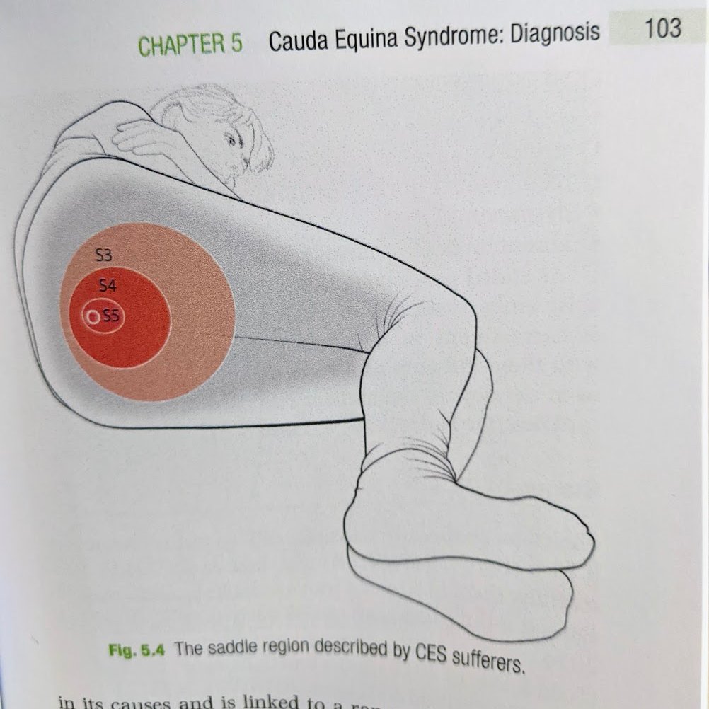 A few notes on a 'loss of saddle sensation', one of the five red flags for cauda equina syndrome... 🧵