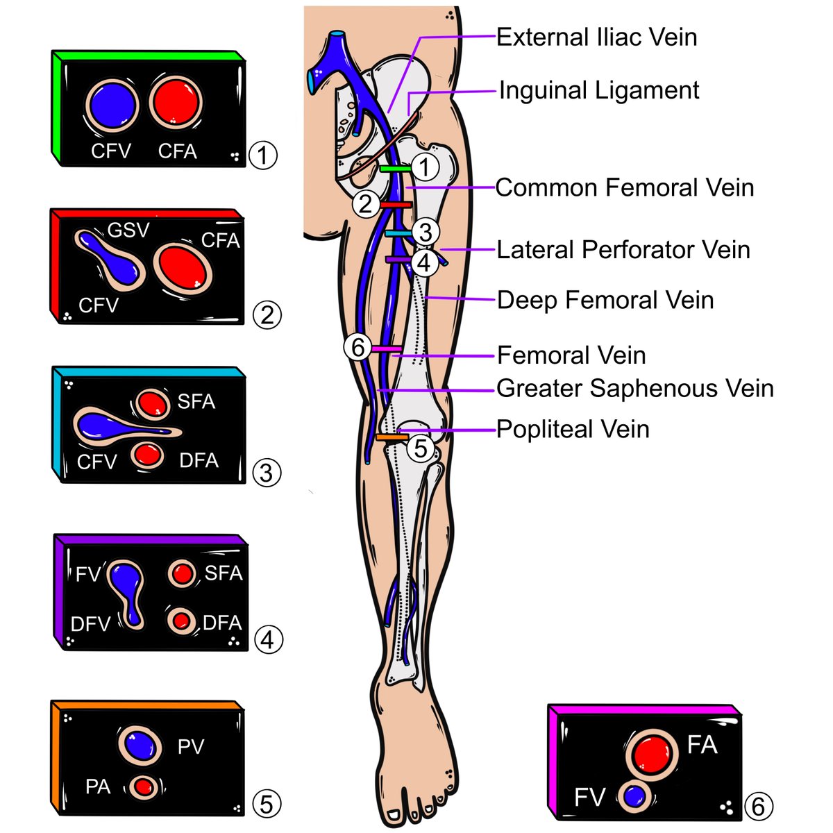 Lower extremity vascular anatomy – important figure to know for DVT #POCUS / #ultrasound 

Image by <a href="/anesthesiacbf10/">David Convissar, MD</a> 
🔗dx.doi.org/10.3791/64601-v