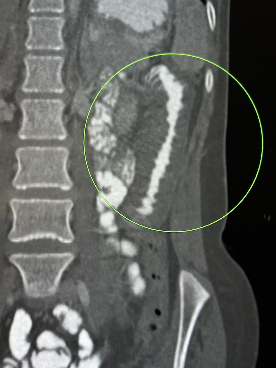 samrad77's tweet photo. CT of thumb printing: 

Almost any cause of bowel wall thickening can give this morphology. 

Today’s case
@amanullahbeg https://t.co/w619mQIEz6