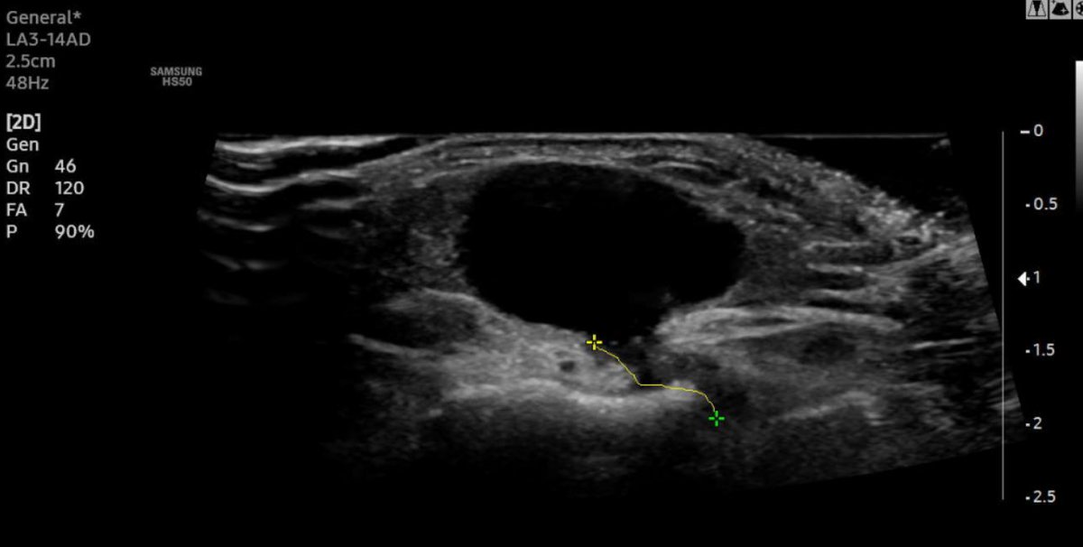 5th tarsometatarsal joint dorsal ganglion cyst #foamed #foamrad #elearnrad #drbabu #rad #radres #kuwait #medtwitter #ultrasound #mskrad #msk #ortho