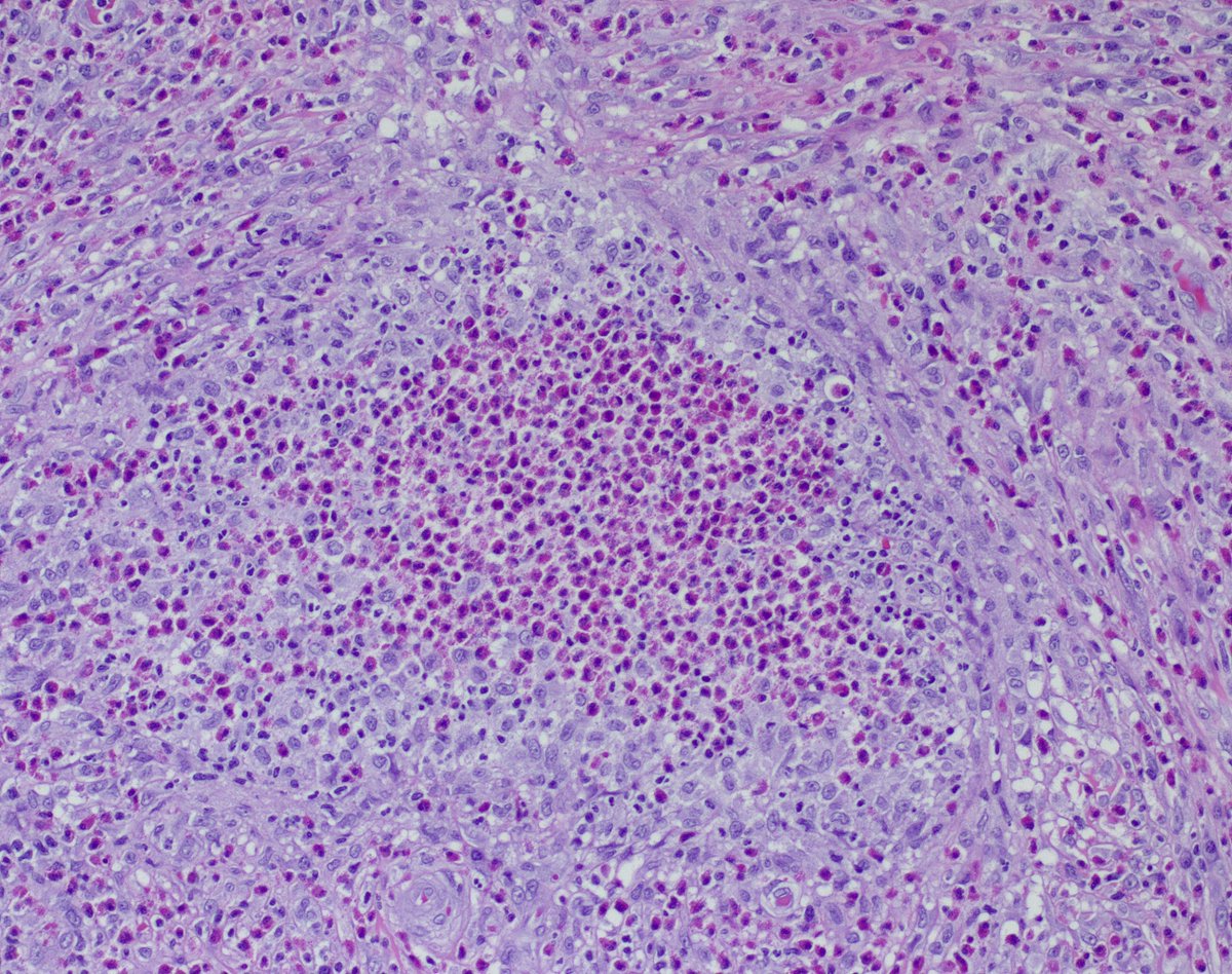 20s♂️ in good health, 4 months hx of 'cyst' axilla. 
Tons of eos, mostly in the dermis, also focally in the epidermis. 
Slam dunk persistent/exuberant arthropod 'bite', or something else? 
What would you include in the ddx? Ty!
<a href="/mccalmo/">Tim McCalmont</a> <a href="/HENRYY_MD/">Henry YANG</a> <a href="/PIorfino/">Dermpath_doc_trish</a> <a href="/DiegoMoralesN/">Diego Morales, MD</a> <a href="/et565/">Etan Marks, DO</a>