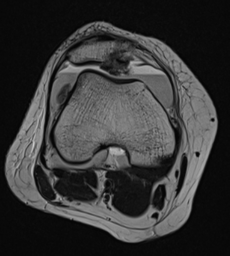 Hemarthrosis Acute patellar dislocation Axial T2w MRI of knee #foamed #foamrad #elearnrad #drbabu #rad #radres #kuwait #medtwitter #msk #knee #MRI #msk