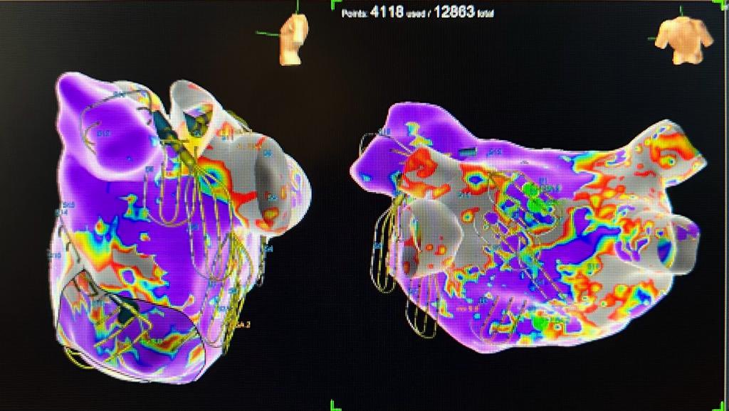DJ Lakkireddy (@dj_lakkireddy) on Twitter photo <a href="/KcHeartrhythm/">KCHRI</a> enrolled the first #StarApollo study. A great new frontier AI powered Ablation using the <a href="/RhythmAI/">i-co.s</a> platform. <a href="/krishpothineni/">Krishna Pothineni</a> <a href="/RichardSchilli2/">Richard Schilling</a> <a href="/jeffschultz/">jeffschultz</a> <a href="/OPRMC/">OverlandParkRegional</a> <a href="/HCAMidwest/">HCA Midwest Health</a> <a href="/rajeshkabramd/">Rajesh Kabra</a> <a href="/drrakeshg1/">Rakesh Gopinath</a> <a href="/KoerberScott/">Scott Koerber</a> <a href="/josoriomd/">Jose Osorio</a> <a href="/SaumilOzaMD/">Saumil Oza</a> <a href="/HRSonline/">Heart Rhythm Society</a> <a href="/KcHeartrhythm/">KCHRI</a> enrolled the first #StarApollo study. A great new frontier AI powered Ablation using the <a href="/RhythmAI/">i-co.s</a> platform. <a href="/krishpothineni/">Krishna Pothineni</a> <a href="/RichardSchilli2/">Richard Schilling</a> <a href="/jeffschultz/">jeffschultz</a> <a href="/OPRMC/">OverlandParkRegional</a> <a href="/HCAMidwest/">HCA Midwest Health</a> <a href="/rajeshkabramd/">Rajesh Kabra</a> <a href="/drrakeshg1/">Rakesh Gopinath</a> <a href="/KoerberScott/">Scott Koerber</a> <a href="/josoriomd/">Jose Osorio</a> <a href="/SaumilOzaMD/">Saumil Oza</a> <a href="/HRSonline/">Heart Rhythm Society</a>