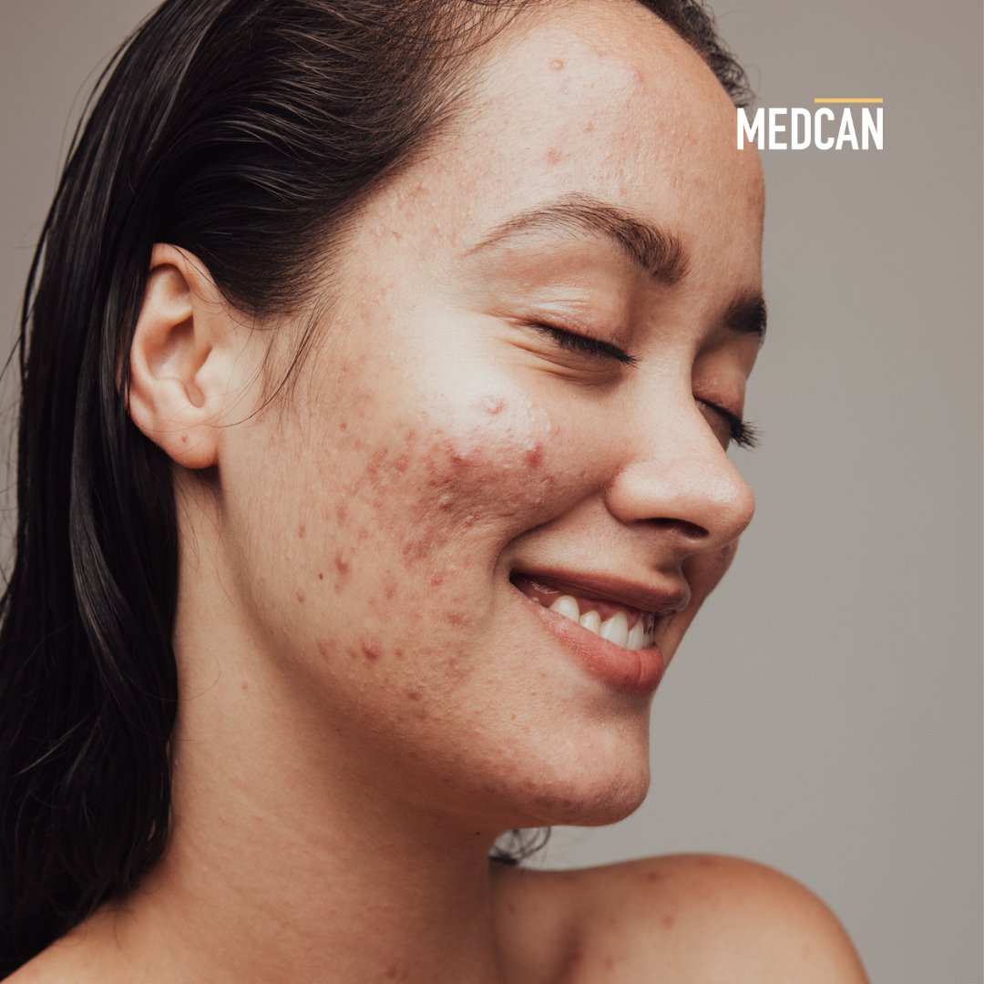 #Acne has many causes. Your #diet, #skincare products, and hormones can all play a part. Listen to Ep. 187 of the #EatMoveThink podcast with double-board certified dermatologist, Dr. Jennifer Tran to learn about causes, treatments and more: bit.ly/3rrtqxR