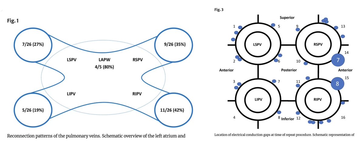 🚨New #OpenAcces Article in
@JICE_EP

Characterization of Durability & Reconnection Patterns at Time of Repeat Ablation after Single-Shot Pulsed Field PVI

by @MRuwald @haugdalm @ReneWorck @arnejohannesse7 @LockMorten @SamKSorensen & @JimHans06778872 

📖🧐doi.org/10.1007/s10840…