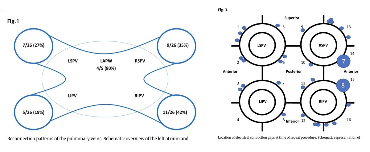 🚨New #OpenAcces Article in @JICE_EP Characterization of Durability & Reconnection Patterns at Time of Repeat Ablation after Single-Shot Pulsed Field PVI by @MRuwald @haugdalm @ReneWorck @arnejohannesse7 @LockMorten @SamKSorensen & @JimHans06778872 📖🧐doi.org/10.1007/s10840…