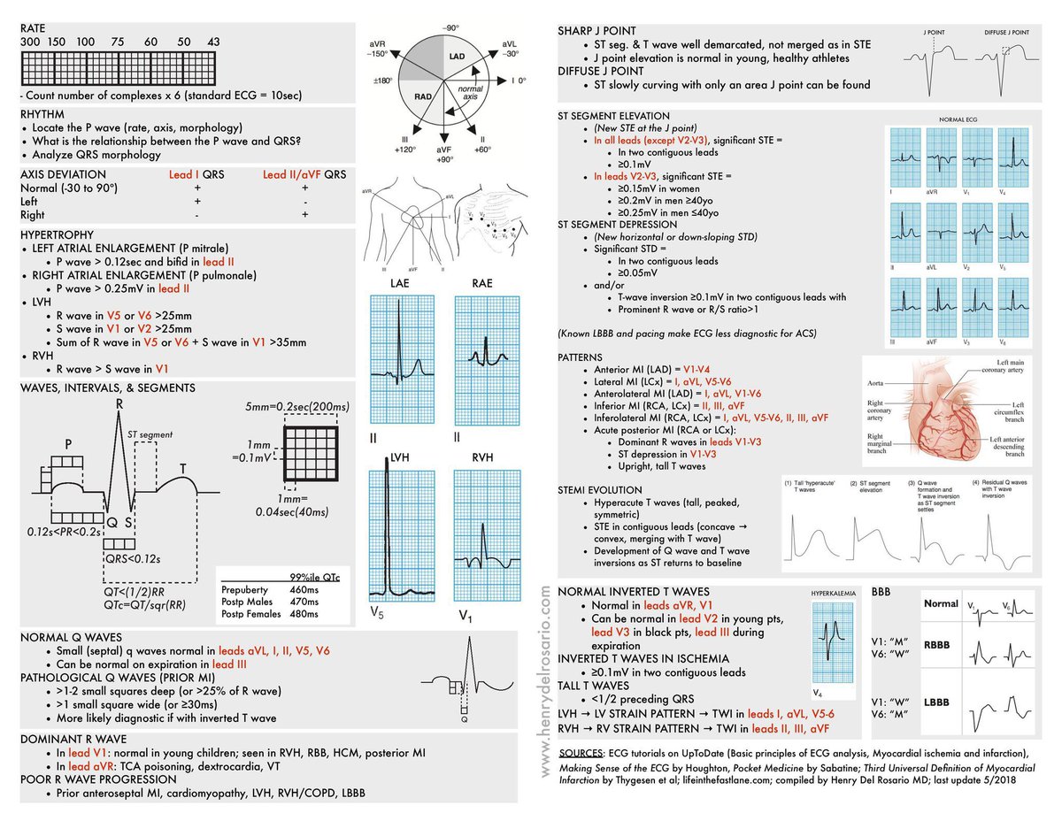 BrownJHM's tweet photo. EKG interpretation cheat sheet by Dr. Henry Del Rosario #MedEd https://t.co/zJBma3Xnbk