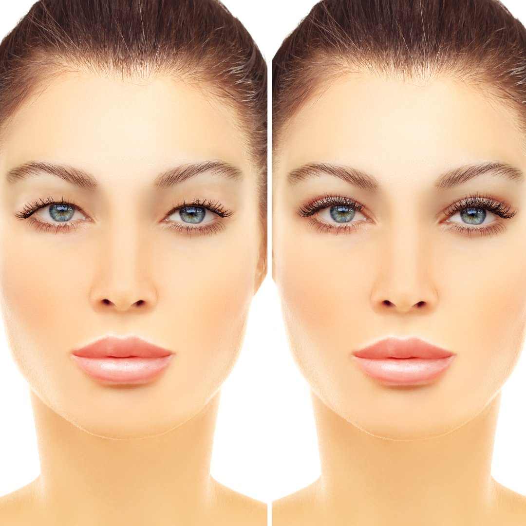 What Is Blepharoplasty and How Does It Help?

See more: 1l.ink/72LD553

#AdvancedCosmeticSurgeryandLaserCenter #351Face #Botox #CosmeticSurgeon #Cincinnati #Ohio #PlasticSurgeon #MedicalSpa #Skincare #Injectables #LaserTreatments #EyelidSurgery #Blepharoplasty