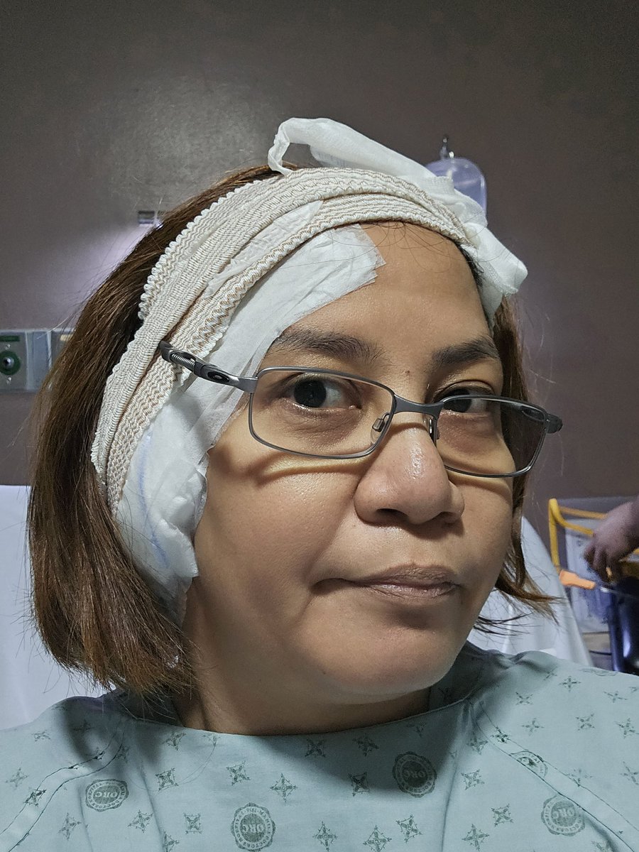 jiltedsummer's tweet photo. Tympanomastoidectomy done! After living with infection in my right my entire life, finally braved to go under the knife. 
I know my hearing will not get better but I hope the infection has not reached my brain.
#tympanoplasty
#mastoidectomy
#earinfection
#hearingloss https://t.co/QOfHP1c8IA