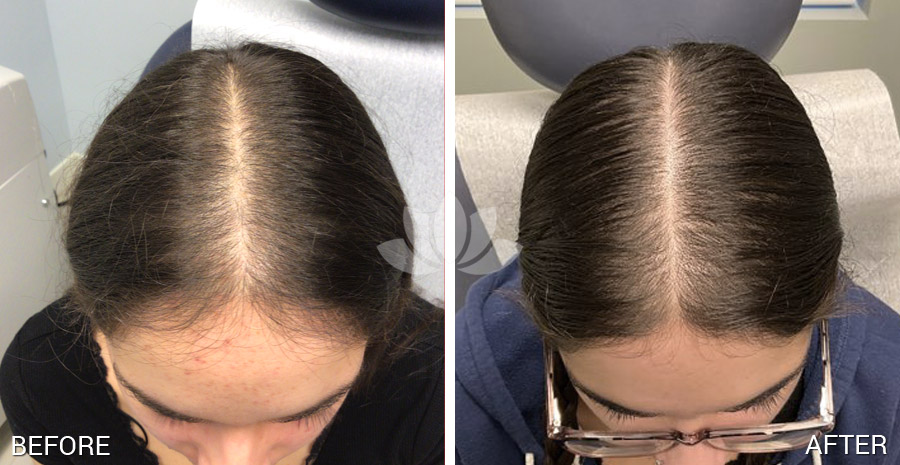 HighlyRatedPros's tweet photo. Hair loss treatment by dermatologist in South Miami FL: Dr. Perez-Quintairos. Check monthly promotions and more before and after pictures of general dermatology and cosmetic treatments at: https://t.co/2eDNbR1rRZ

#dermatologist #southmiami #florida #hairloss https://t.co/Fgy494OPeI