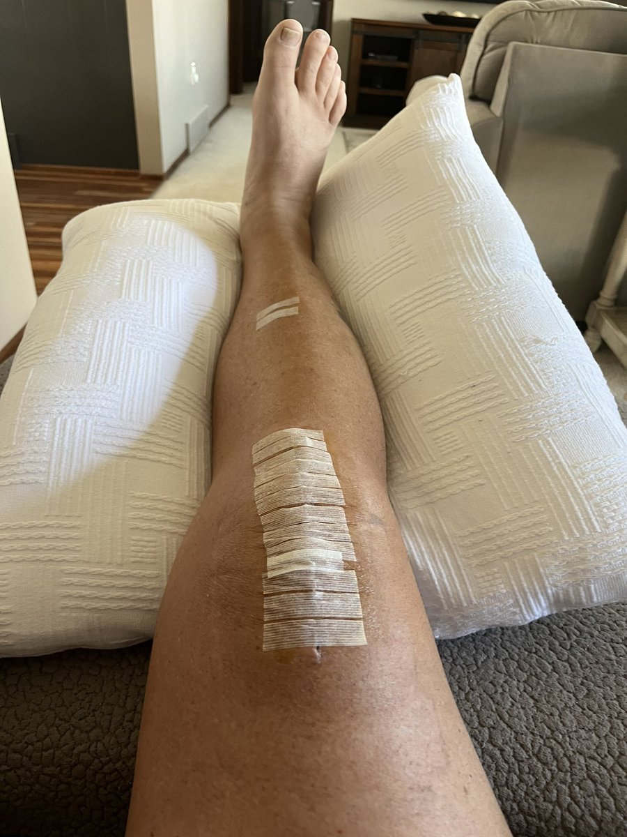 brianspotts57's tweet image. Tomorrow marks 2 weeks since knee replacement surgery!  Stitches in shin out today, large bandage removed and Steri-Strips added.  Cut on knee was glued and healing nicely.  First rehab I was at 90 degree range of motion…today I’m at 105. #DoTheWork #GoalsToMeet