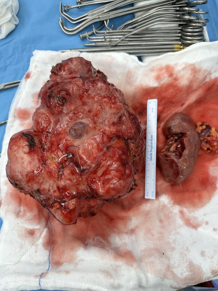 Palpable chemoresistant giant retroperitoneal leiomyosarcoma, managed w/ a challenging transperitoneal excision of the mass, left radical nephrectomy(including adrenal gland) , splenectomy, distal pancreatectomy in collab w/ general surgery and MuratKars #urosome #urooncology