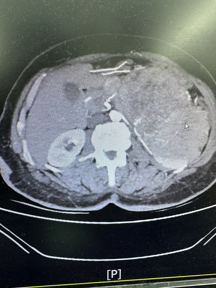 YnsmreGenc's tweet photo. Palpable chemoresistant giant retroperitoneal leiomyosarcoma, managed w/ a challenging transperitoneal excision of the mass, left radical nephrectomy(including adrenal gland) , splenectomy, distal pancreatectomy in collab w/ general surgery and MuratKars #urosome #urooncology https://t.co/ricKbBINhd
