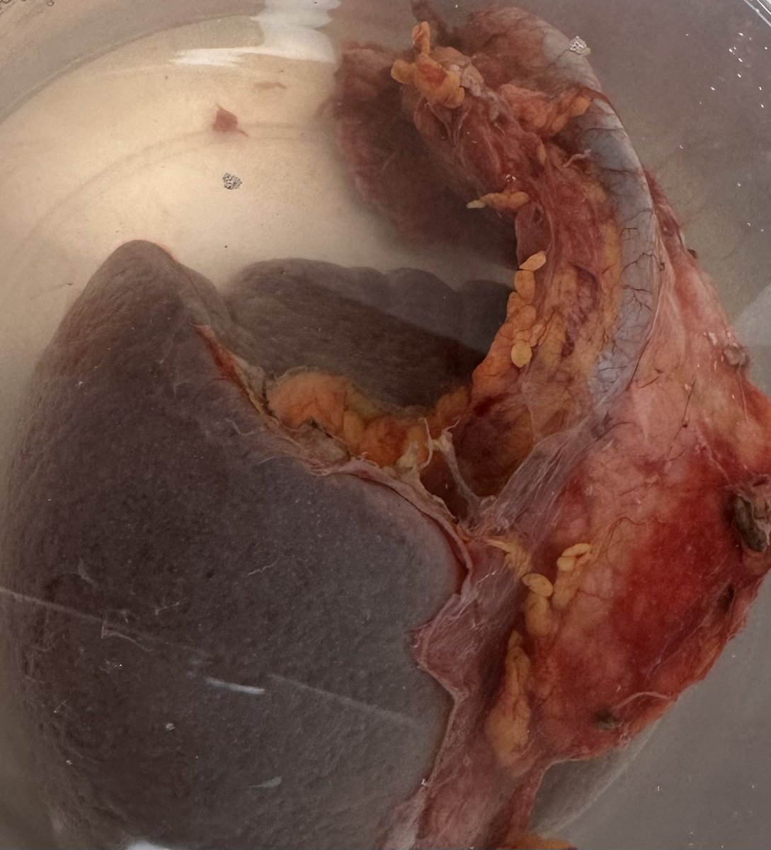 YnsmreGenc's tweet photo. Palpable chemoresistant giant retroperitoneal leiomyosarcoma, managed w/ a challenging transperitoneal excision of the mass, left radical nephrectomy(including adrenal gland) , splenectomy, distal pancreatectomy in collab w/ general surgery and MuratKars #urosome #urooncology https://t.co/ricKbBINhd