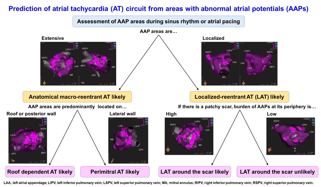 CirculationEP's tweet photo. Abnormal atrial potentials in sinus rhythm or atrial pacing suggest slow conduction in atrial tachycardias. Their distribution can help predict tachycardia circuits 
#AHAJournals #Epeeps 
https://t.co/wl1nGH9kAb https://t.co/dxxRiU1kdv
