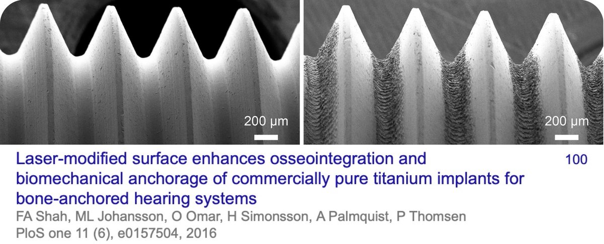 Palmquist Lab (@labpalmquist) on Twitter photo Proud to see that our paper on #osseointegration of laser-modified titanium implants, work done in collaboration with Martin Johansson and Hanna Peters from <a href="/OticonMedical/">Oticon Medical</a> is cited 100 times, within a few short years. bit.ly/3rAS1Ao
<a href="/SahlgrenskaAcad/">Sahlgrenska Academy</a> <a href="/goteborgsuni/">Göteborgs universitet / University of Gothenburg</a> Proud to see that our paper on #osseointegration of laser-modified titanium implants, work done in collaboration with Martin Johansson and Hanna Peters from <a href="/OticonMedical/">Oticon Medical</a> is cited 100 times, within a few short years. bit.ly/3rAS1Ao
<a href="/SahlgrenskaAcad/">Sahlgrenska Academy</a> <a href="/goteborgsuni/">Göteborgs universitet / University of Gothenburg</a>