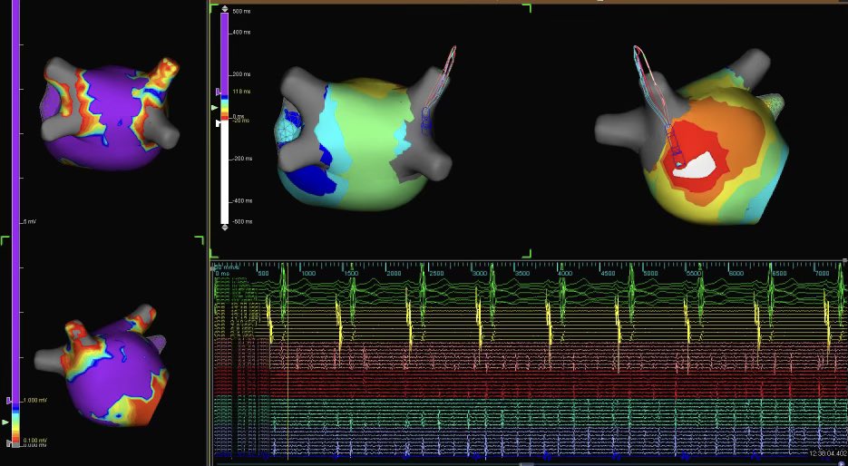 HX Cryo PVI. Variable exit prior to touch up with #TactiCath, post ablation vein still in AF #PMA