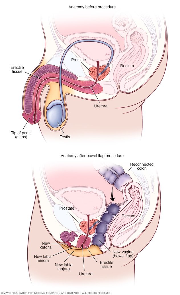 Before &amp; after bottom surgery.  One thing remains the same.  The male prostrate.   It’s only men who can get prostrate cancer.   Trans women are still men.