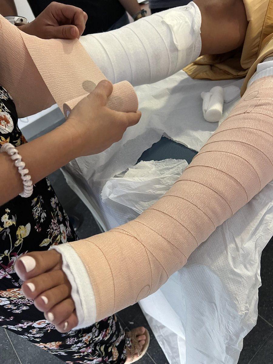 EPAHERIDASCC's tweet photo. Seguimos formando profesionales del #DistritoAljarafeSevillaNorte en el abordaje de las lesiones de extremidad inferior 
Fisiopatologia 
Diagnóstico diferencial 
Clínica 
Casos clínicos 
#Terapiadecompresión #DSASN #heridascronicas #epaheridas https://t.co/0IAV5kspZZ