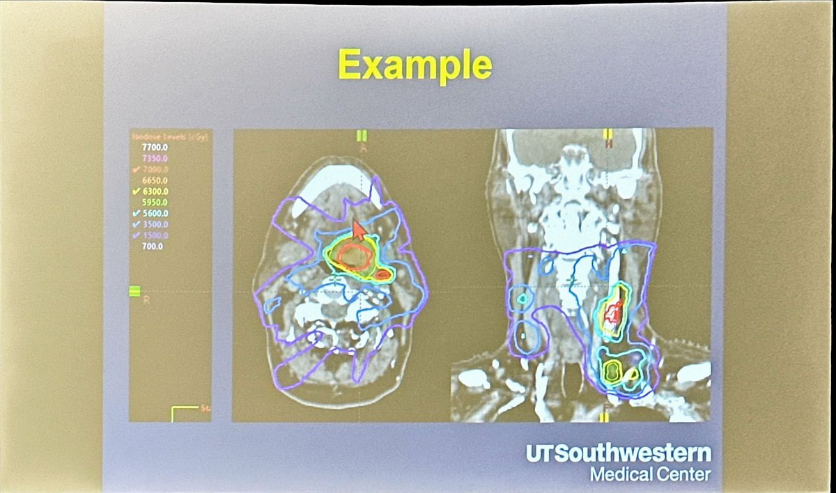 _ShankarSiva's tweet photo. @DavidSherMD presents late breaking abstract DARTBOARD, Randomized trial of adaptive H&amp;N #radiotherapy using 1mm margin. ➡️ Feasibility demonstrated. PRO improvement observed.  
➡️ Nice use of advanced #radonc techniques! 👏🏽👏🏽
💰Cost-effectiveness analysis needed? https://t.co/3MZCDXfFw6