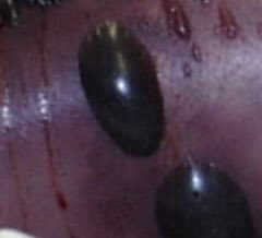 IUIDfellowship's tweet image. #idboardreview A pt with colon cancer develops septic shock, hemolysis and purple bullae at surgical site post colectomy. Pic for Ref #IDTwitter #idmeded #meded