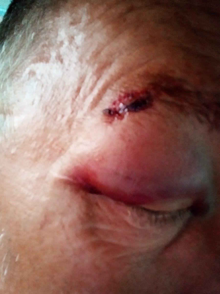 TrumpIsBack7's tweet image. Well, I got elbowed in the eye today while subduing, a resisting suspect, who me and my partner pulled over for driving a stolen vehicle. Now he has an added charge.