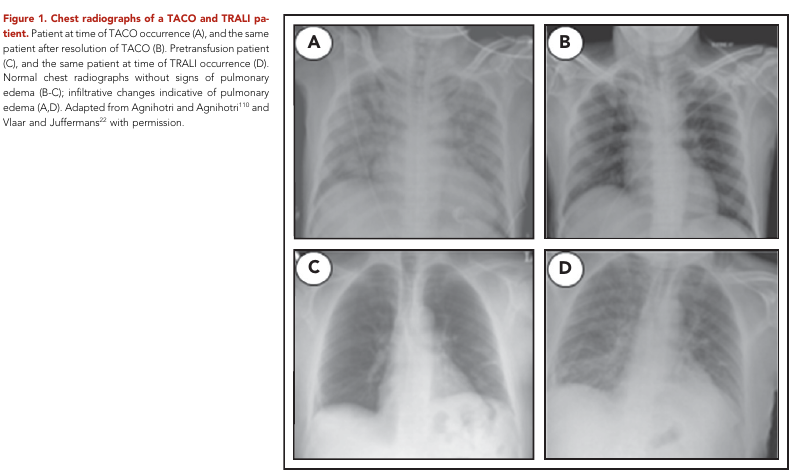MHcsba's tweet photo. BLOOD 2019: TACO y TRALI
#MedEd #MedTwitter 
DOI:10.1182/blood-2018-10-860809. https://t.co/s1g6OVXO3l