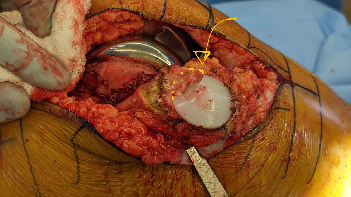 Trollplasty's tweet photo. Patellae need friends too. https://t.co/3zYtHq8sl7