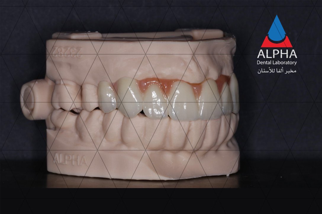 As we age, our teeth change in shape and structure. At Alpha Digital Dental Lab, we craft restorations tailored to each stage of life. 
Check out this 8-unit zirconia bridge for a 45-year-old female patient! 🦷👵