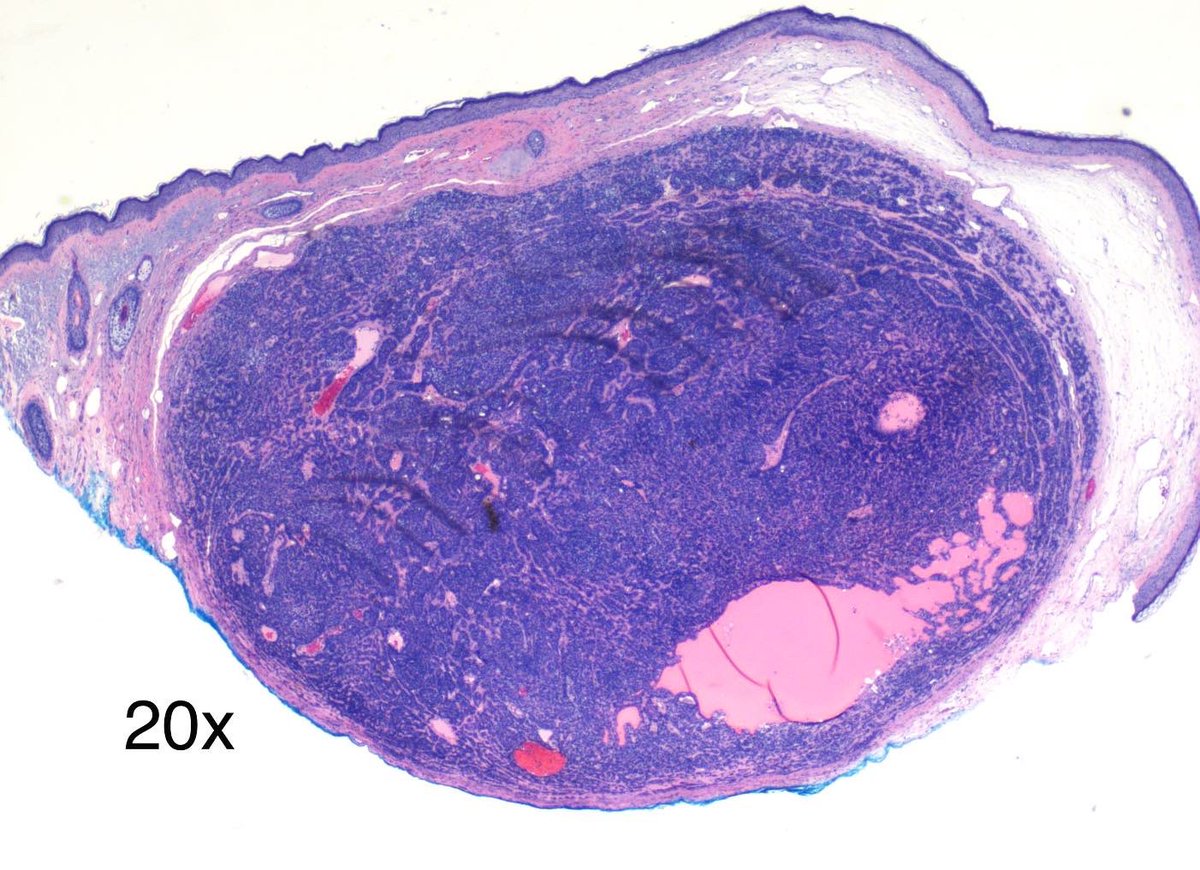 79 year old female. Tragus.  SCC vs BCC vs Neurofibroma 

Stains: 
Positive: Sox-10 (not billed)

#skin #dermpath #dermatology #dermatopathology #pathology #surgicalpathology #surgpath  #pathtwitter #pathresident