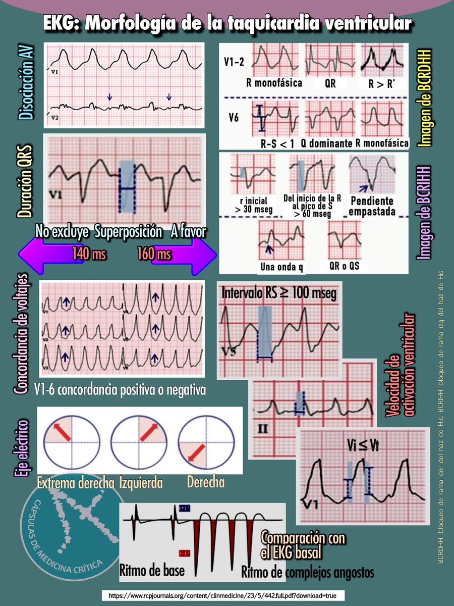 Electrocardiograma de la taquicardia ventricular…

Fuente: Diagnosis and management of ventricular tachycardia. Clinical Medicine (2023). 

Cápsula 530.

rcpjournals.org/content/clinme…