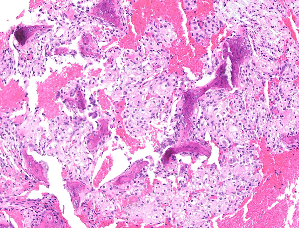 Osteosarcoma or chondrosarcoma? Not such a simple question! #BSTpath