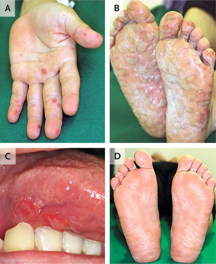 36-y-o ♂️: blisters on his palms (A) and soles (B) and ulcerations on his tongue (C), fevers, malaise, and a sore throat.
1 wk before, his 2- & 4-y-o children had had similar symptoms
1/2

DOI: 10.1056/NEJMicm1713548
#IDtwitter #IDfellowship #microbiology