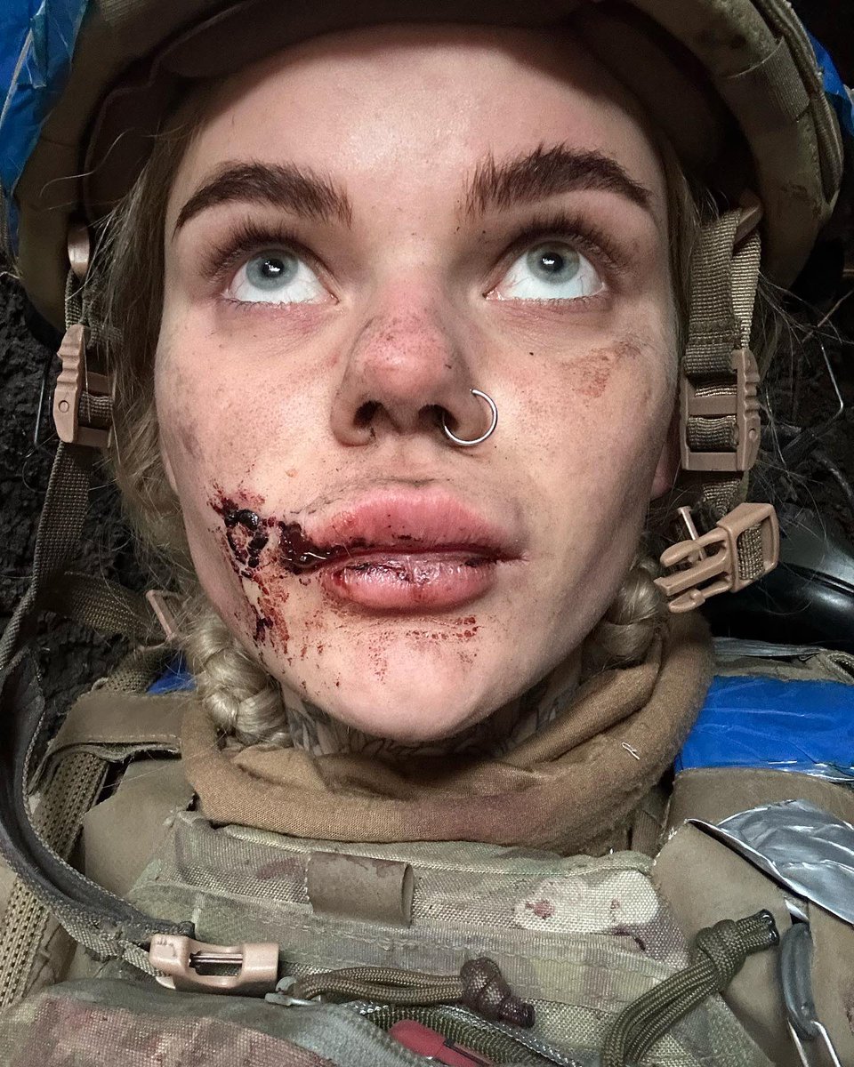 KyivPost's tweet photo. ❤️‍🩹This is Anastasia Mutsei, a brave Ukrainian medic who was injured during the recent fighting on the front line.

She's a true symbol of courage. Glory to Heroes!🇺🇦

📷: Anastasia Mutsei / Instagram https://t.co/fDnBw2KdqP