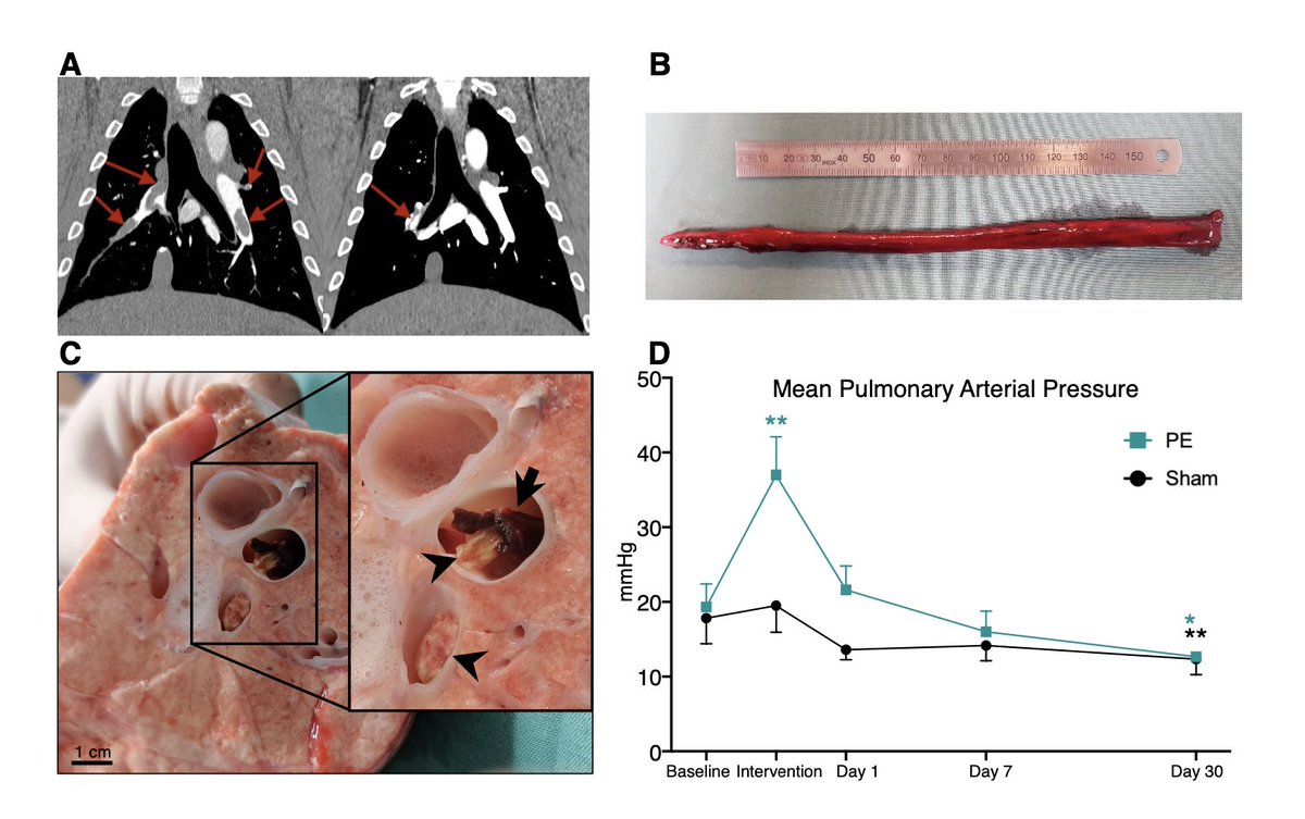 🫀 New publication in <a href="/ThrombosisRese1/">Thrombosis Research</a> by <a href="/SimoneDragsbaek/">Simone Juel Dragsbæk</a> et al.

A porcine model of #ChronicThromboembolicPulmonaryDisease  was developed🐖🫁 

Autologous emboli was used, and showed resemblance to human #CTEPH in chronic clot formation 🩸🔬

link: sciencedirect.com/science/articl…
