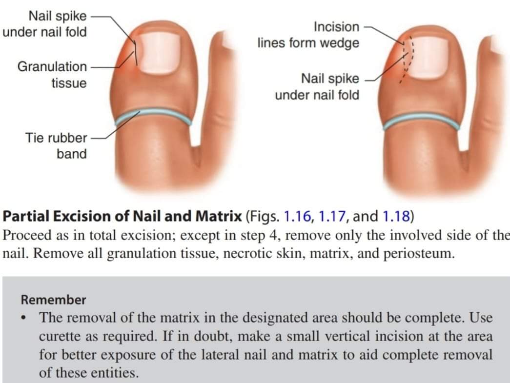 Removal of ingrown toenail surgery (Wedge Resection) - Manadr