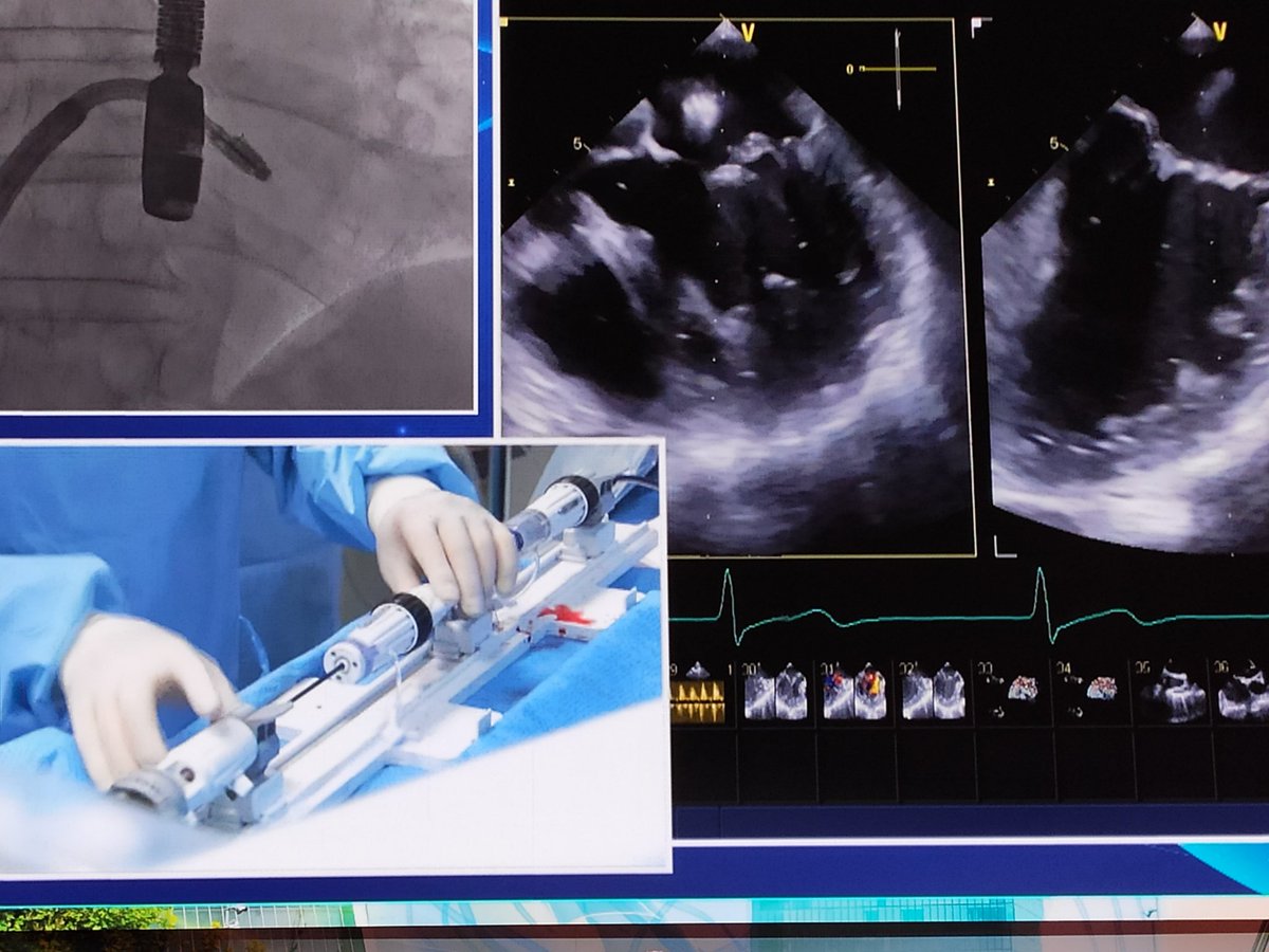 MatteoReccia (@recciamatteo) on Twitter photo Percutaneous treatment of SHD in Italy from Padua (TEER) to ROME (PFO CLOSURE). The importance of selecting the best device for the best result.Berti, <a href="/azeemlatib/">Azeem Latib</a>, @G_Tarantin,SangiorgiGaspardone, <a href="/MariannaAdamo1/">Marianna Adamo</a>,Bedogni,
<a href="/MASSIMO90417726/">MASSIMO FINESCHI</a>, <a href="/jgranadacrf/">Juan F. Granada</a>,Grasso,Musto,<a href="/sicigise/">Sici GISE</a> Percutaneous treatment of SHD in Italy from Padua (TEER) to ROME (PFO CLOSURE). The importance of selecting the best device for the best result.Berti, <a href="/azeemlatib/">Azeem Latib</a>, @G_Tarantin,SangiorgiGaspardone, <a href="/MariannaAdamo1/">Marianna Adamo</a>,Bedogni,
<a href="/MASSIMO90417726/">MASSIMO FINESCHI</a>, <a href="/jgranadacrf/">Juan F. Granada</a>,Grasso,Musto,<a href="/sicigise/">Sici GISE</a>