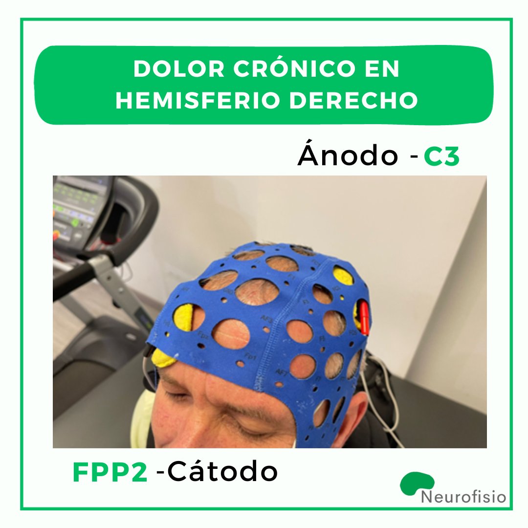 Neurofisio11's tweet photo. La corriente directa transcraneal es una herramienta que utilizamos para diversas patologías. Una de ellas, es el dolor crónico, el cual ha tenido buenos resultados en este tipo de pacientes. ¿Quieres conocer un poco más sobre este tratamiento? Pincha aquí https://t.co/wlypY58VSp https://t.co/p8DLPda68s