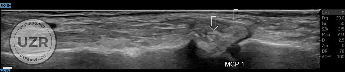 Rheumatology's tweet photo. Ultrasound quiz
Level: easy - moderate
We see hyperechoic structures in the UCL of MCP 1 and within the flexors DIG V and within A1-Pulley DIG V.
What is your diagnosis? https://t.co/cHJ4iSZUyt