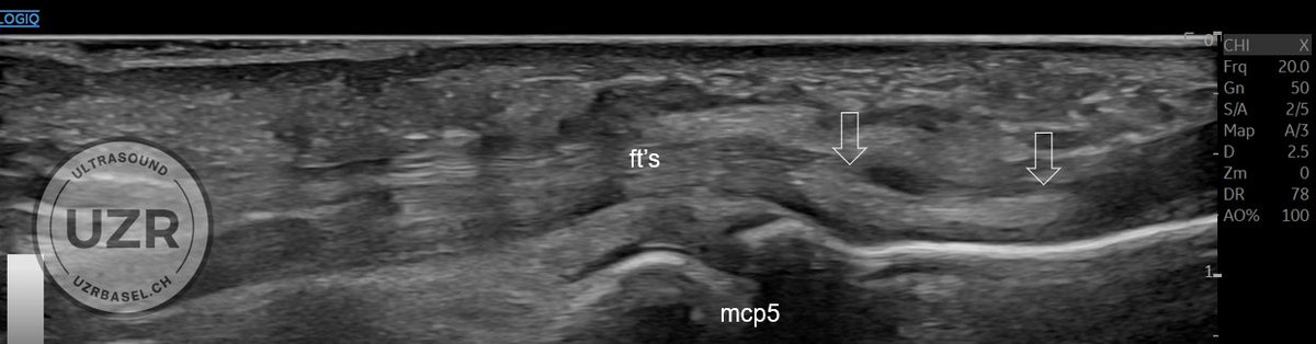 Rheumatology's tweet photo. Ultrasound quiz
Level: easy - moderate
We see hyperechoic structures in the UCL of MCP 1 and within the flexors DIG V and within A1-Pulley DIG V.
What is your diagnosis? https://t.co/cHJ4iSZUyt