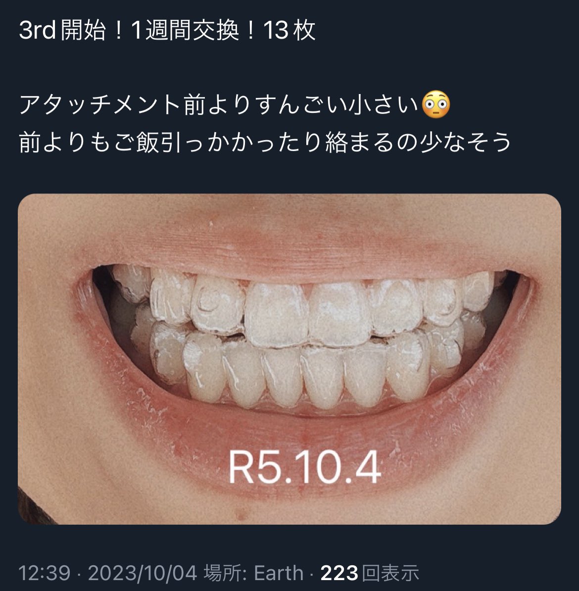 7aaah_'s tweet photo. 改めて経過をツリーに。
ほぼ1年サボってたから気持ち入れ替えて頑張る！（今だけ）

アライナー付けててわかりにくいけど前のポストとアタッチメントの大きさを比べて欲しい😂 https://t.co/uOTa7rbqBK