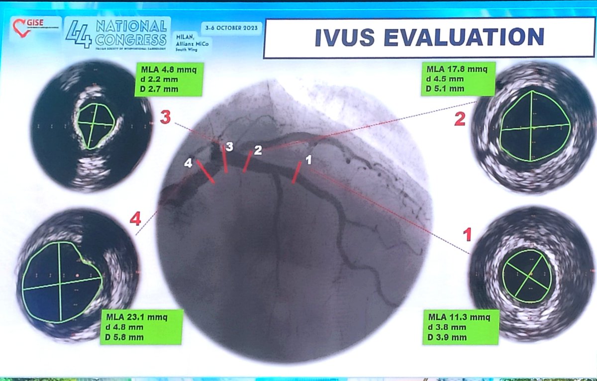 MatteoReccia (@recciamatteo) on Twitter photo Treatment of LM in pts with reduction EF: Just do It simple and fast (unorotected provisional) or complex but safe (protected DKB)
<a href="/giuseppemusum11/">Giuseppe Musumeci</a>, <a href="/vlgmrc/">Marco Valgimigli</a>, <a href="/ChiaraFraccaro/">Chiara Fraccaro</a>, <a href="/alaide_chief/">chief</a>,
<a href="/belcid7/">Belén Cid Alvarez</a>,<a href="/sicigise/">Sici GISE</a>,<a href="/francesco_saia/">Francesco Saia</a> Treatment of LM in pts with reduction EF: Just do It simple and fast (unorotected provisional) or complex but safe (protected DKB)
<a href="/giuseppemusum11/">Giuseppe Musumeci</a>, <a href="/vlgmrc/">Marco Valgimigli</a>, <a href="/ChiaraFraccaro/">Chiara Fraccaro</a>, <a href="/alaide_chief/">chief</a>,
<a href="/belcid7/">Belén Cid Alvarez</a>,<a href="/sicigise/">Sici GISE</a>,<a href="/francesco_saia/">Francesco Saia</a>