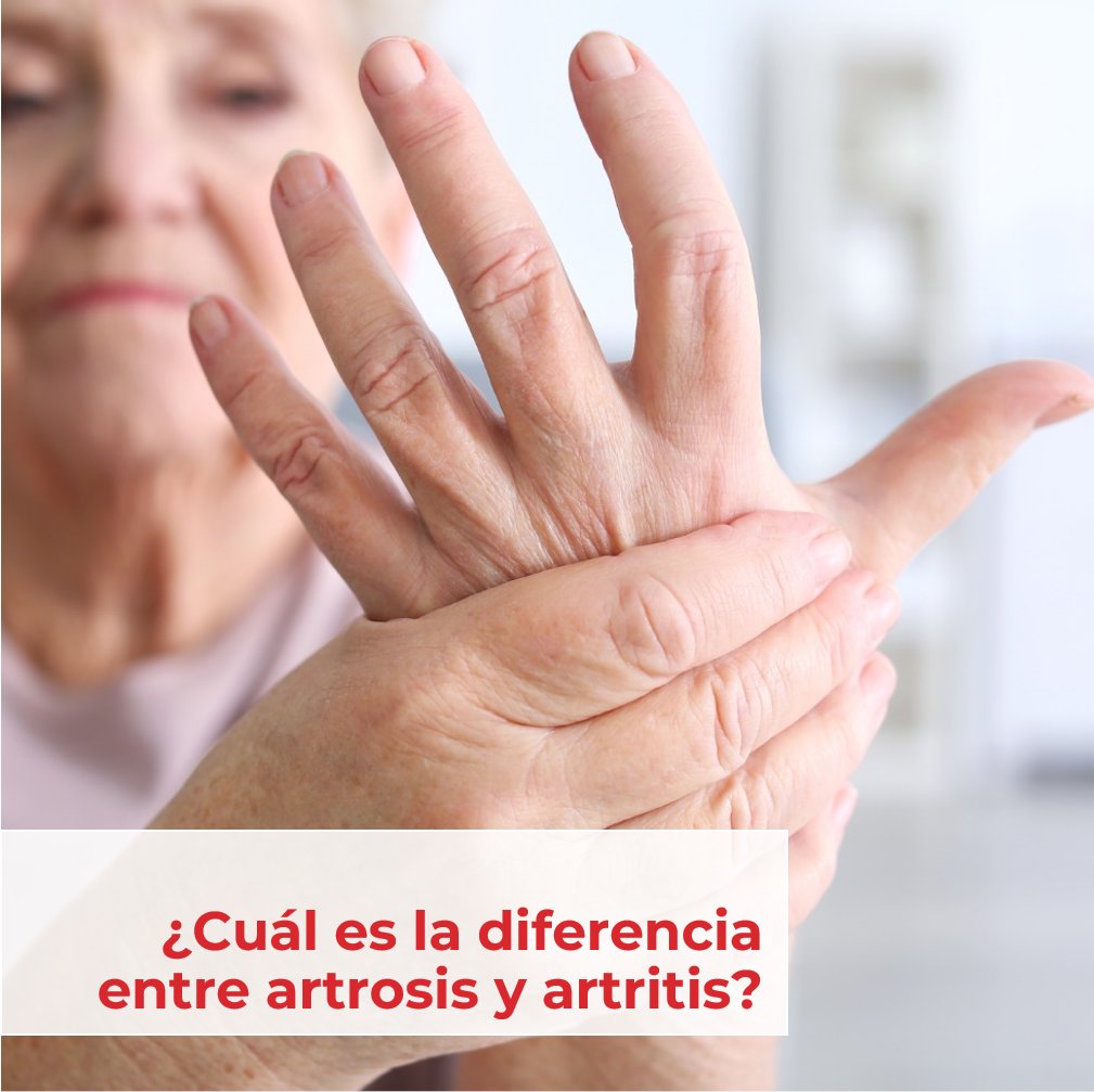 ¿En qué se diferencian artrosis y artritis?🧐
bit.ly/3Q2XhpM