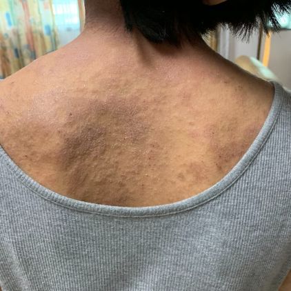 GoGetFunding's tweet photo. Jade is raising funds for Cold Atmospheric Plasma (CAP) treatment which is a very expensive treatment but is proving very successful for TSW sufferers. 

Want to help Jade get her life back? Visit:

https://t.co/LhGSHbDZds

#TSW #CAPtreatment #crowdfunding #medicalfundraising https://t.co/pYvFLMlCZ5