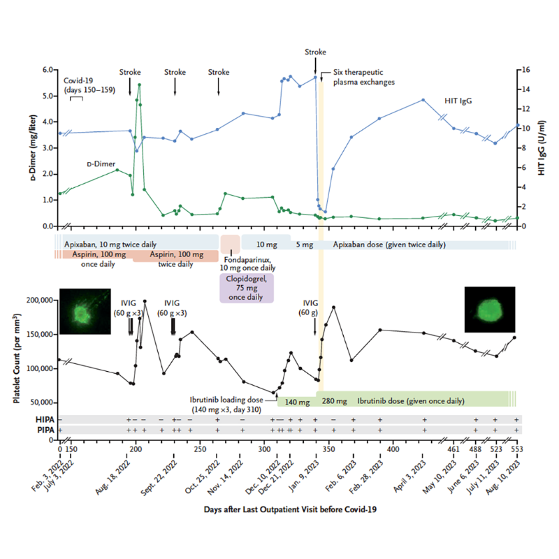 NEJM's tweet photo. A woman with multiple episodes of pulmonary embolism and venous thrombosis who had platelet-activating antibodies to PF4 was treated with high-dose IVIG, plasma exchange, and daily ibrutinib after several strokes.  

🔗 Read the full correspondence: https://t.co/2W77RYEB82