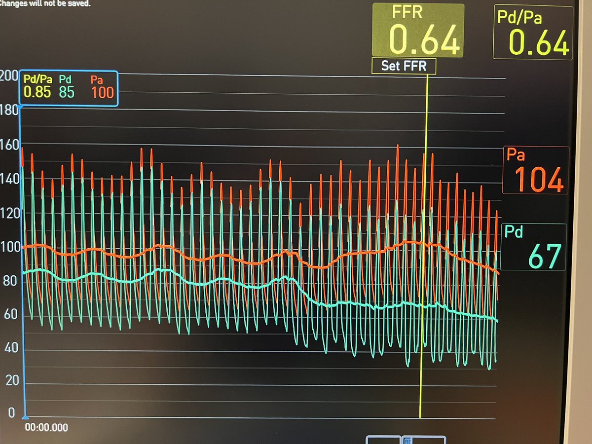 It’s done, 1st case in Europe. Perfect correlation with FFR. Great technology. <a href="/SomersetFT/">Somerset NHS Foundation Trust</a> <a href="/Medtronic/">Medtronic</a> <a href="/CathWorks/">CathWorks</a> @tor_warr <a href="/zoerusso/">Zoe Russo</a>